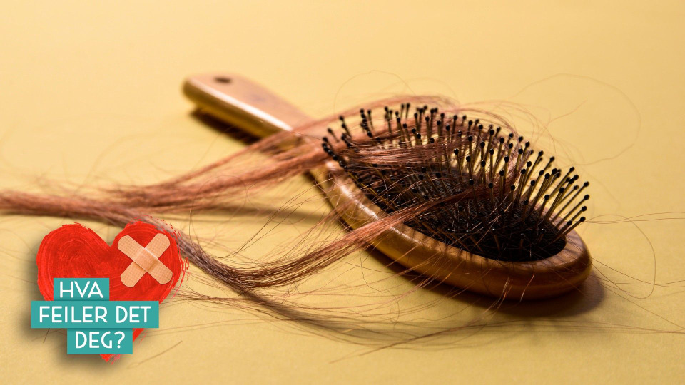 s04e02 — Når du mister håret